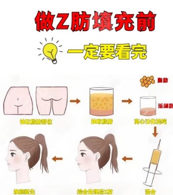 自體脂肪移植術(shù)