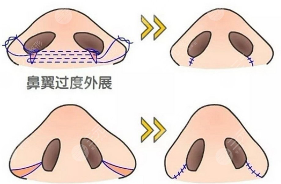 鼻翼縮小