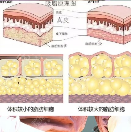 面部吸脂
