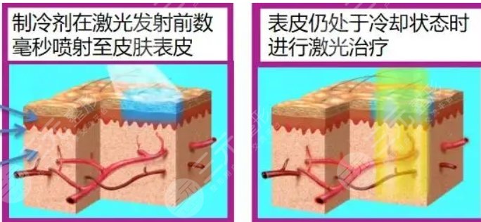 激光