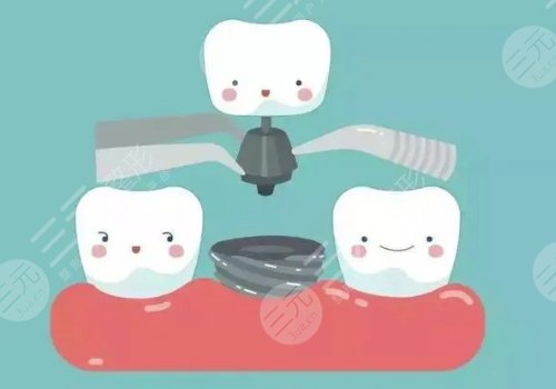 合肥市口腔醫(yī)院種植牙多少錢(qián)