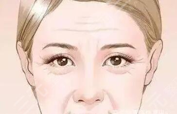 抬頭紋