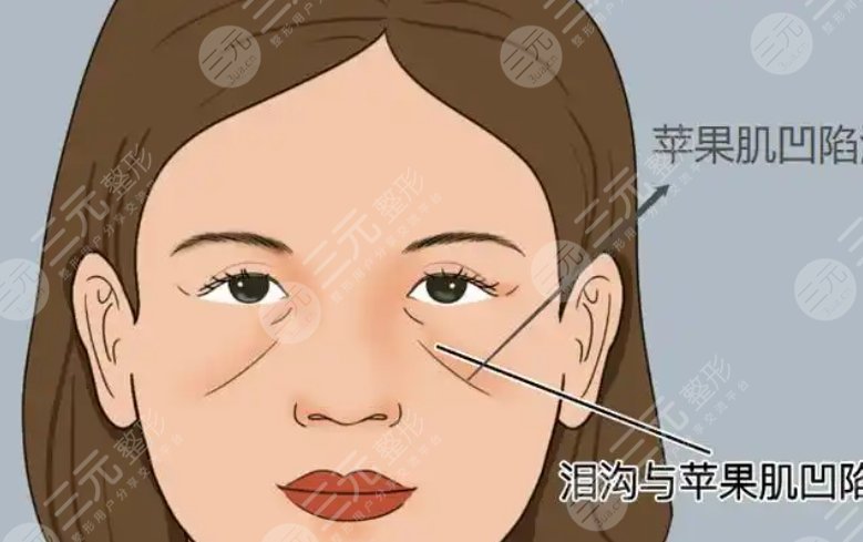蘋果肌填充動(dòng)漫