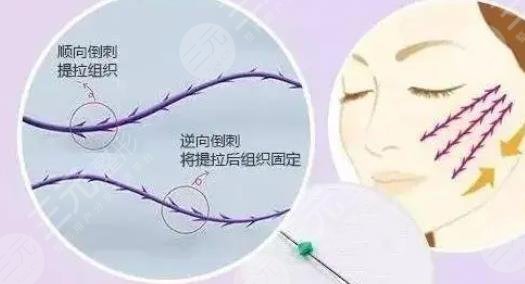 線雕