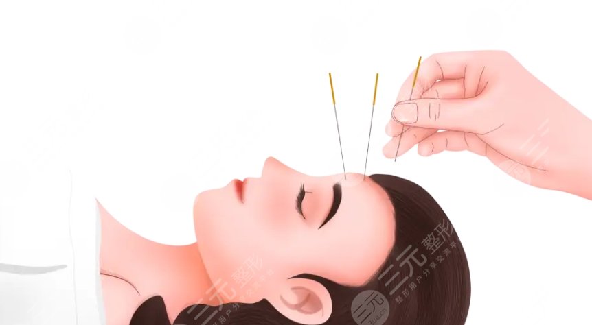 中醫(yī)針灸能面部緊致提升