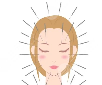 中醫(yī)針灸能面部緊致提升