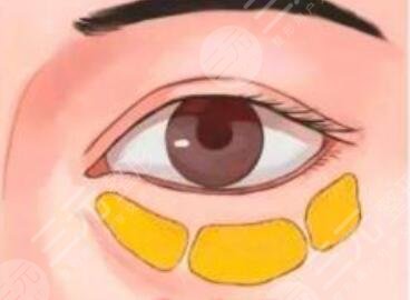 淚溝