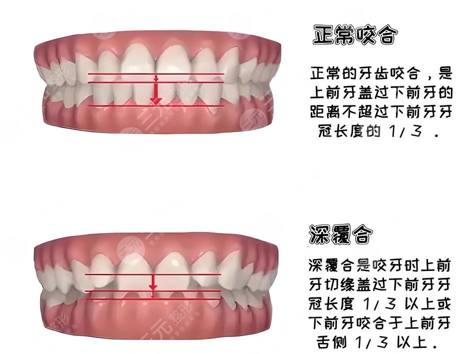 深覆合