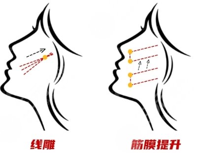 筋膜提升