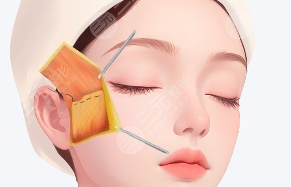 筋膜提升dm