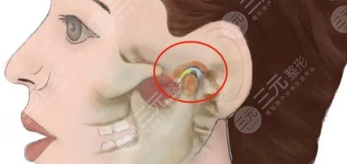 耳前韌帶提升