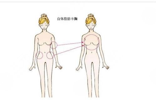 杭州公立醫(yī)院隆胸三巨頭