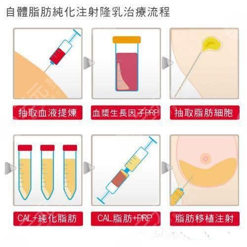 杭州隆胸價格全景圖