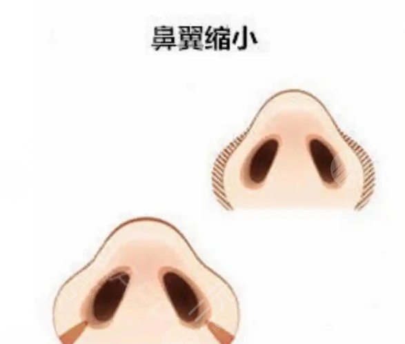 鼻翼縮小