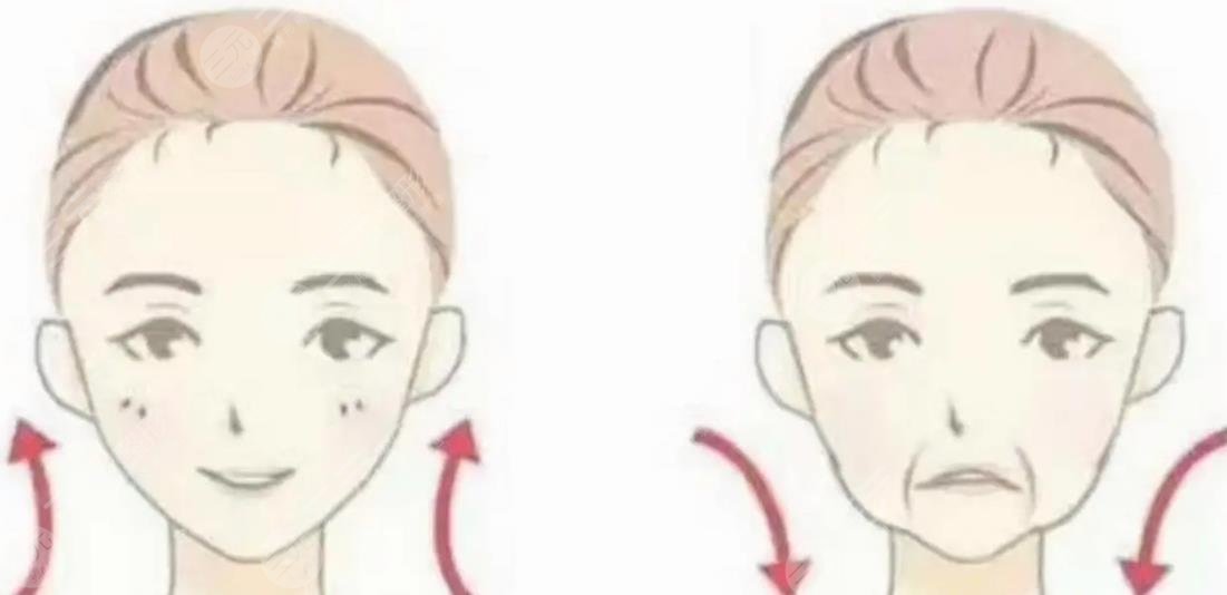 面部提升