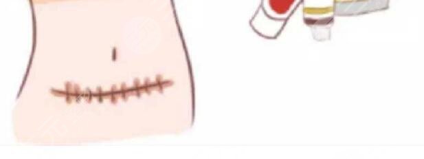 祛疤