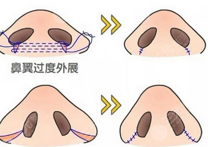 鼻中隔軟骨
