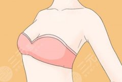 微創(chuàng)去副乳多少錢？多少錢全說透_別再被報(bào)價(jià)忽悠了