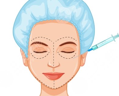 玻尿酸注射