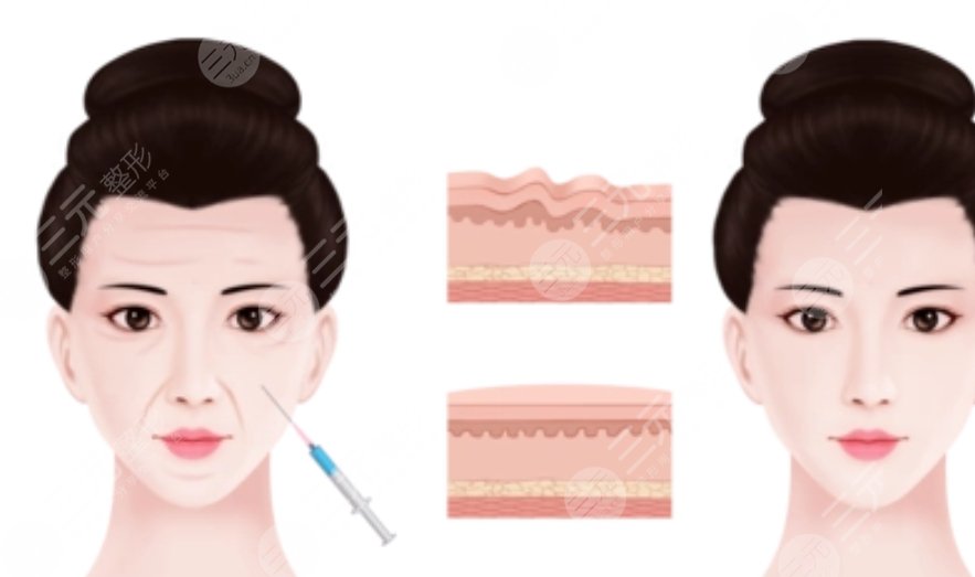 注射除皺