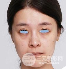 浙江省中醫(yī)院整形美容科殷莉波自體脂肪填充案例
