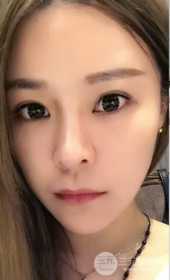 浙江省中醫(yī)院整形美容科殷莉波自體脂肪填充案例